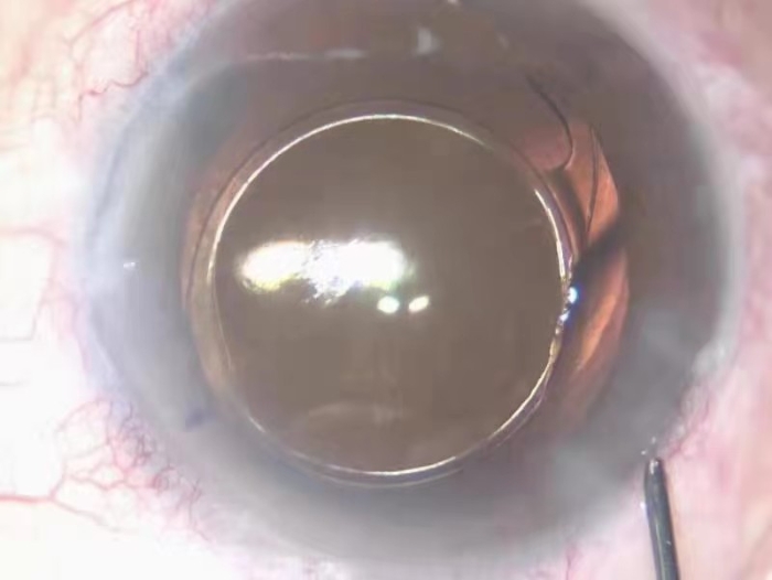 愛博諾德（北京）醫療科技有限公司+人工晶狀體(2)