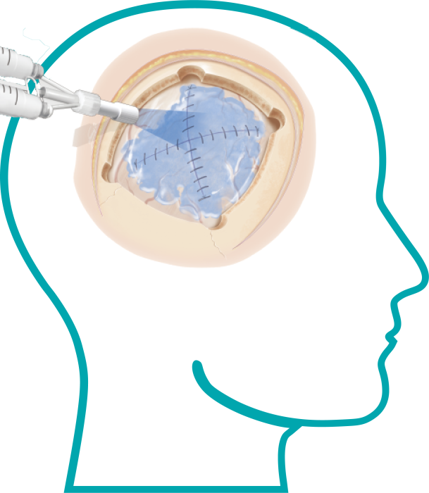 可吸收硬腦膜封合醫用膠照片1